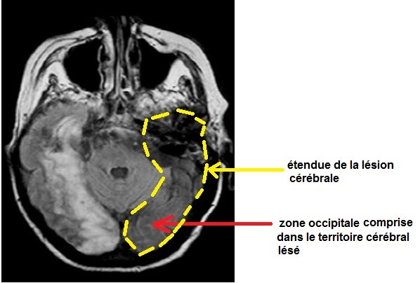 Un patient atteint d'hémianopsie latérale gauche : Cas clinique du Patient  Y – Les SVT avec DB